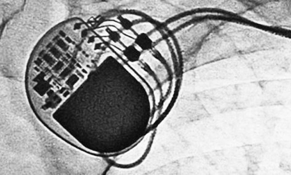 激光焊接在醫療行業技術中的應用(圖2)